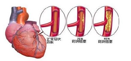 国康全自动生化分析仪分析冠心病的发病原理