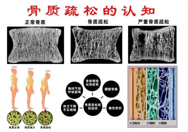 骨密度检测仪